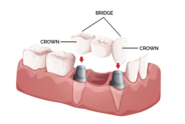 Orthodontic treatment